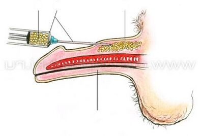 Jinsiy olatni kattalashtirish